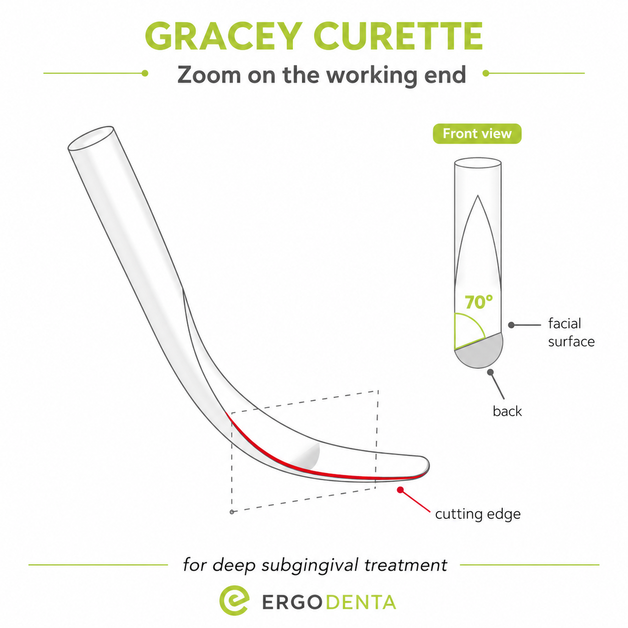 Gracey Curette working end — 70° offset blade, single cutting edge, deep subgingival treatment