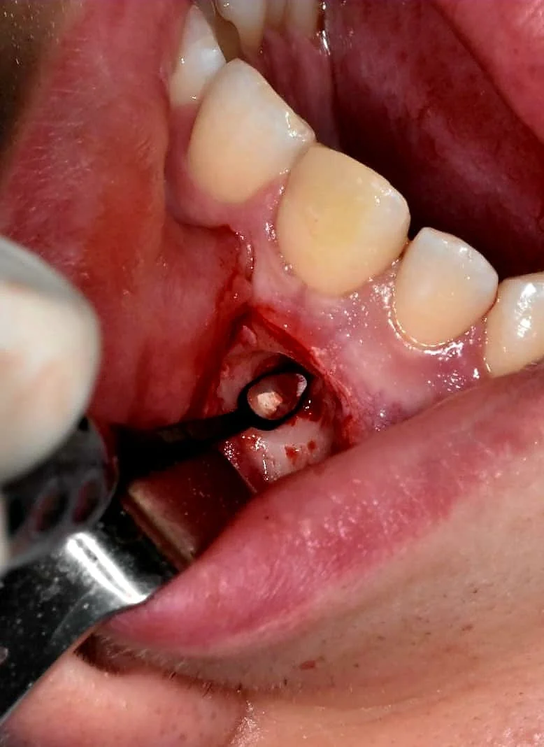 ErgoDenta ultra-thin 0.7 mm endo mirror positioned in the access cavity during microscopic endodontic treatment